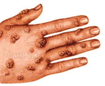 Папилломавирус на кисти руки
